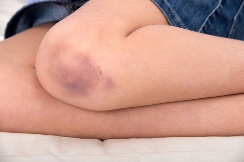 Hematomas nos joelhos