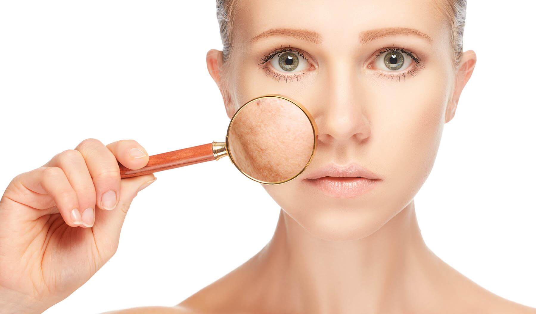 Hiperpigmentação: sinais do rosto que refletem doenças