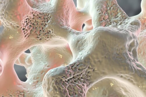 Osteoporose