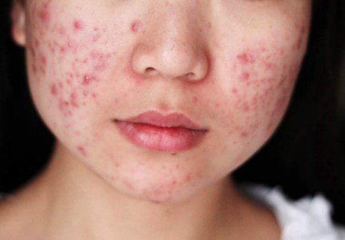 Rosto com acne
