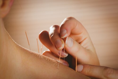Acupuntura: quais são seus benefícios para a saúde?