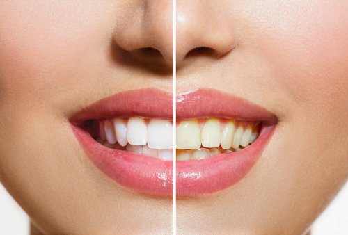 Produtos naturais que ajudarão a clarear os dentes