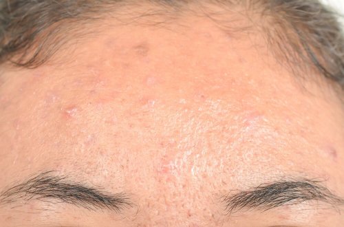 Dermatite seborreica: remédios naturais eficazes