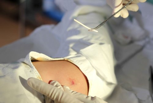 Você pode engravidar com um implante de progesterona?