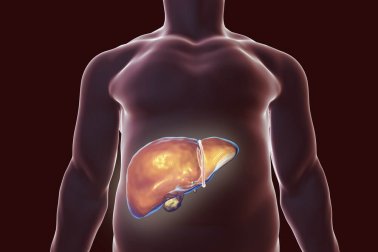 Os melhores remédios naturais para desintoxicar o fígado