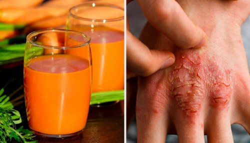 7 remédios naturais para prevenir e combater a psoríase