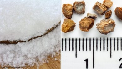 7 remédios caseiros para eliminar as pedras nos rins