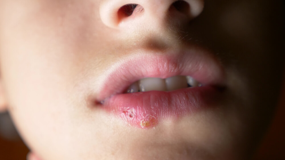 Herpes Em Criancas Como Trata Lo Melhor Com Saude