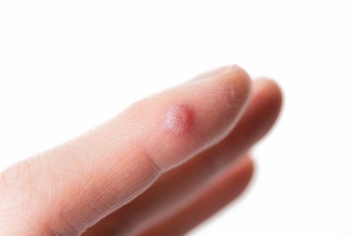 5 soluções para eliminar as verrugas dos dedos
