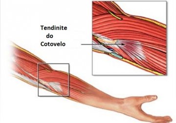 Como acalmar a tendinite com soluções naturais