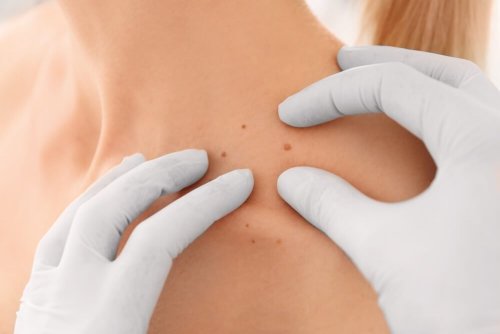 Como prevenir e tratar verrugas através da dieta