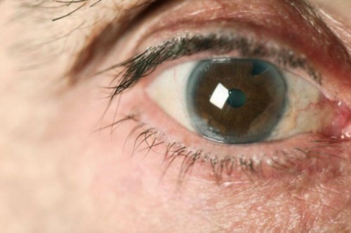 Glaucoma no olho