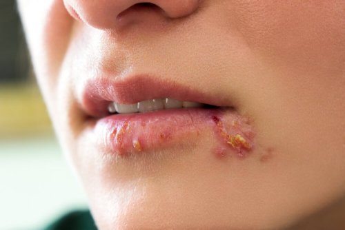 Herpes em crianças: como tratá-lo?