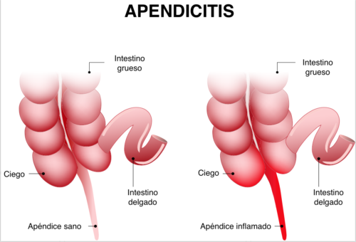 Apêndice inflamado