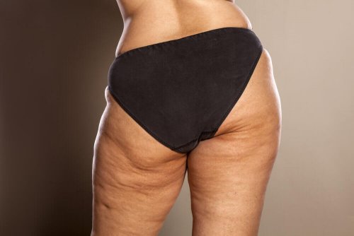 Mulher com celulite