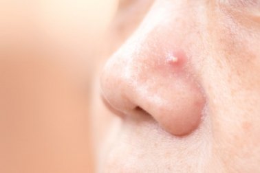 Como abordar os cravos no nariz com 4 remédios caseiros