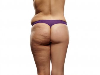 Como fazer uma dieta para reduzir a celulite