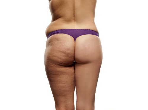 Como fazer uma dieta para reduzir a celulite