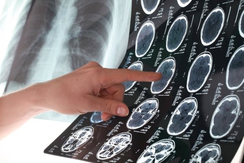 6 dicas para prevenir um derrame
