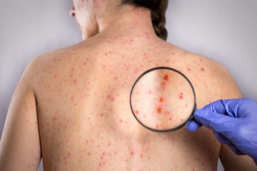 Mulher com sinal de herpes das costas