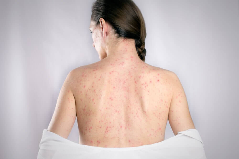 5 remédios para curar herpes das costas 5 remédios para curar herpes das costas