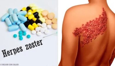 Os 5 melhores remédios para curar herpes das costas