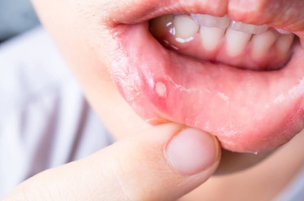 7 formas de curar aftas na boca naturalmente