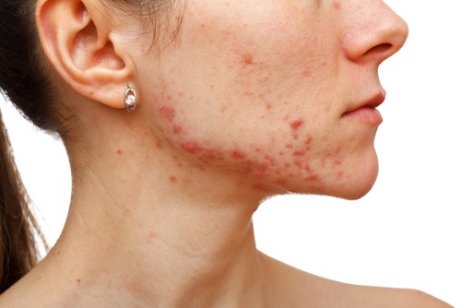 Mulher com acne no rosto