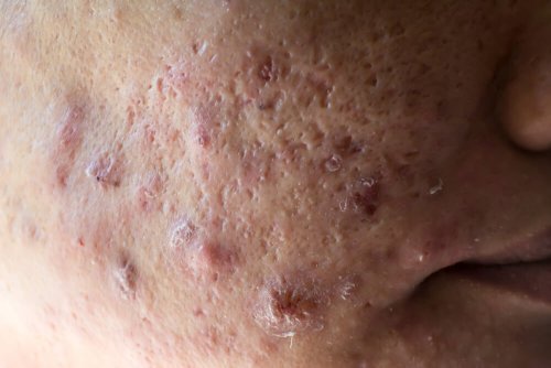 Rosto com acne
