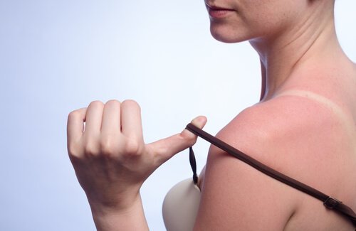 7 remédios naturais para tratar queimaduras de sol