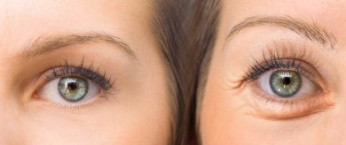 5 ingredientes naturais para firmar as pálpebras
