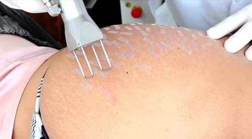 Aparelho para combater as estrias na pele
