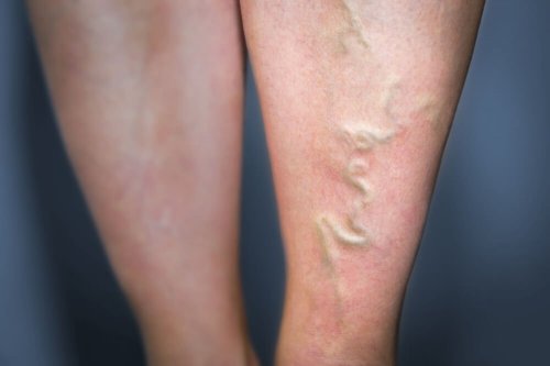 Soluções naturais para tratar a flebite