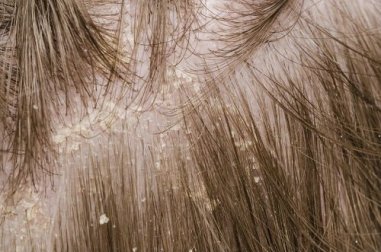 Truque com Aspirinas para combater a caspa