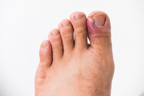 Infecção por unha encravada no dedão
