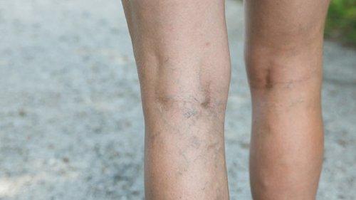 A arnica pode serusada para tratar varizes