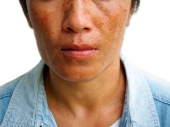 3 tratamentos para reduzir as manchas causadas por melasma