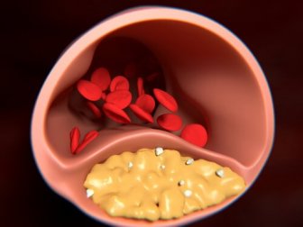 Arteriosclerose: remédios naturais para tratá-la