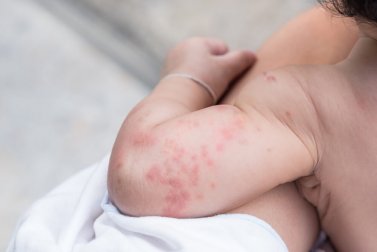 Brotoejas em bebês: devo me preocupar?