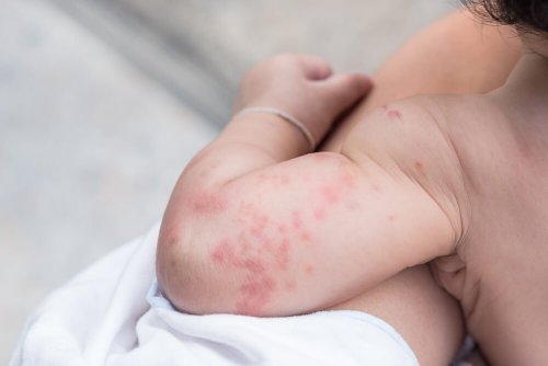 Brotoejas em bebês: devo me preocupar?
