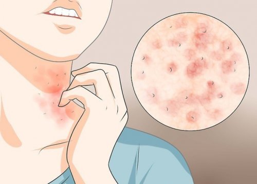 A sarna costuma coçar