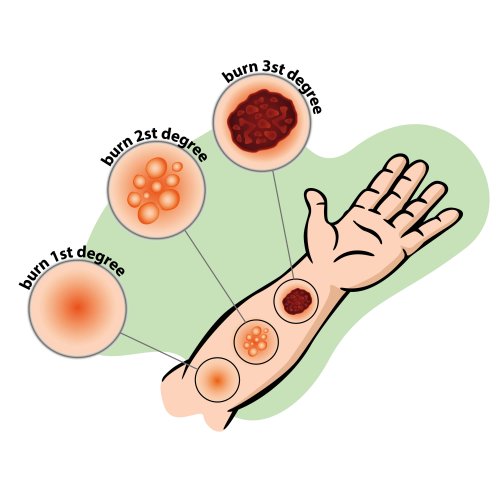 Bicarbonato de sódio para queimadura: como preparar