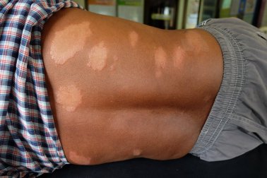Hanseníase: como aliviar seus sintomas naturalmente