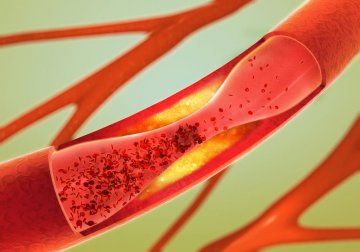 Como cuidar da saúde arterial: 6 hábitos saudáveis