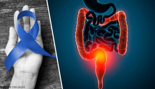 Luta contra o câncer de cólon