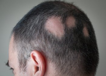 Como combater a alopecia com soluções de origem natural