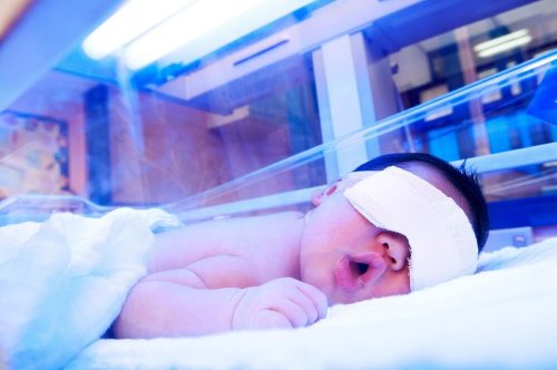 Quando o bebê tem icterícia, precisa de um tratamento com luz 