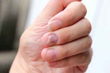 5 remédios naturais para a psoríase nas unhas