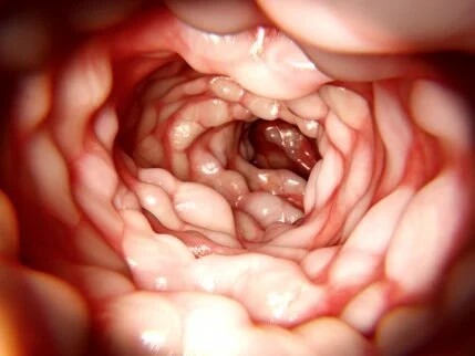 O trato intestinal e a doença de Crohn