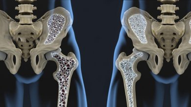 6 dicas para prevenir a osteoporose com a alimentação